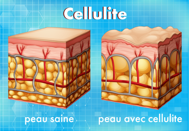 illustration de la structure d'une peau saine et d'une peau affecté par la cellulite