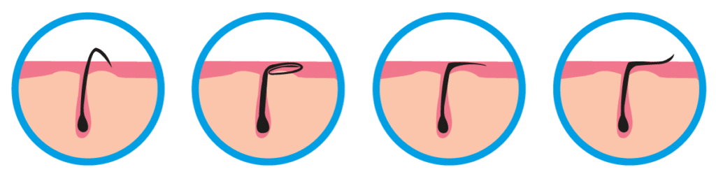 Comment se forme le poil incarné