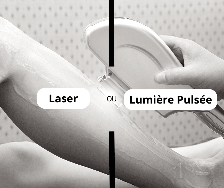 épilation définitive au laser ou à la lumière pulsée